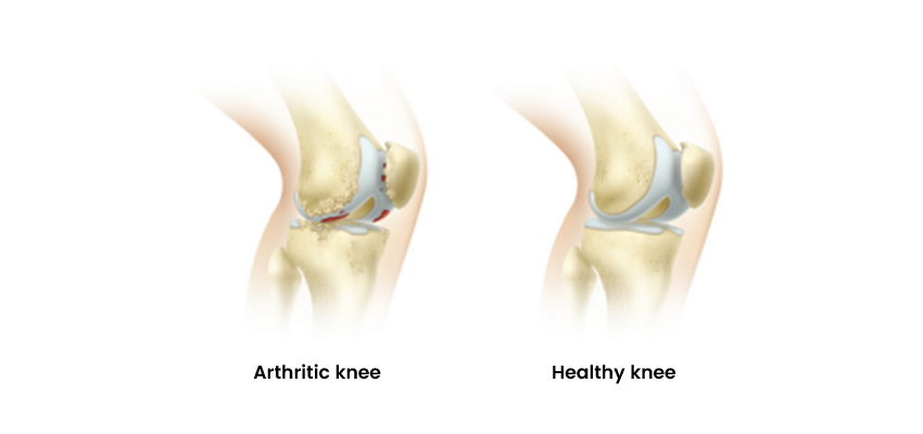 ROSA® Knee System is a Robotic Advancements In Total Knee Replacement to assist surgeon in customizing the precise placement of your knee implant to fit your needs.