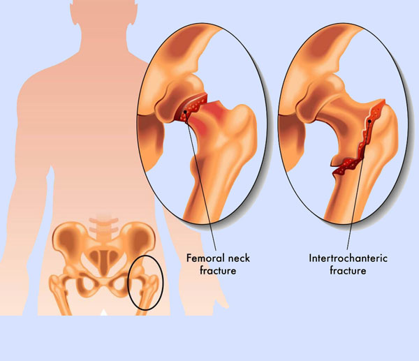 Dr. Kunal Makhija, orthopedic surgeon in Panvel, Navi Mumbai, specializes in Rosaplasty - Painless/Bloodless Subvastus Knee Replacement Surgery at Patel Clinic.