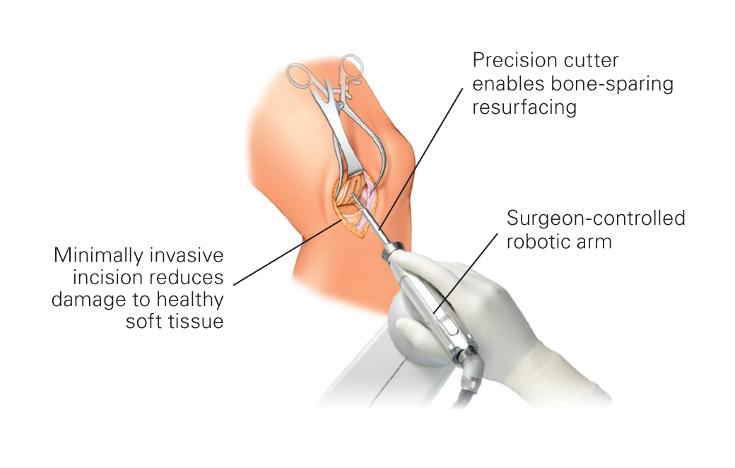 Knee Replacement Surgery With Minimally Invasive Robotics by Dr. Kunal Makhija, orthopedic surgeon in Panvel, Navi Mumbai, specializes in Rosaplasty at Patel Clinic.