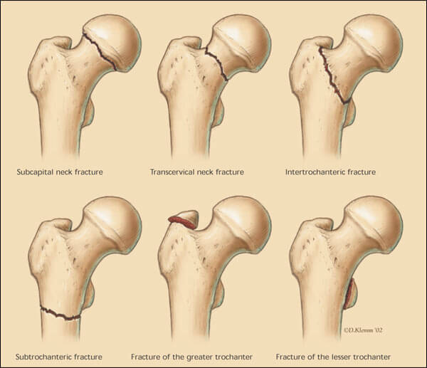 Dr. Kunal Makhija, orthopedic surgeon in Panvel, Navi Mumbai, specializes in Rosaplasty - Painless/Bloodless Subvastus Knee Replacement Surgery at Patel Clinic.